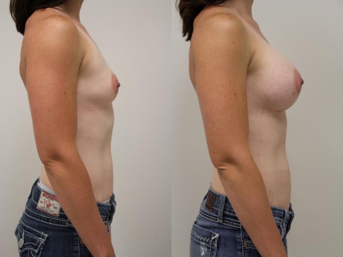 Before & After Breast Augmentation Case 53 View #3 View in Gilbert, AZ