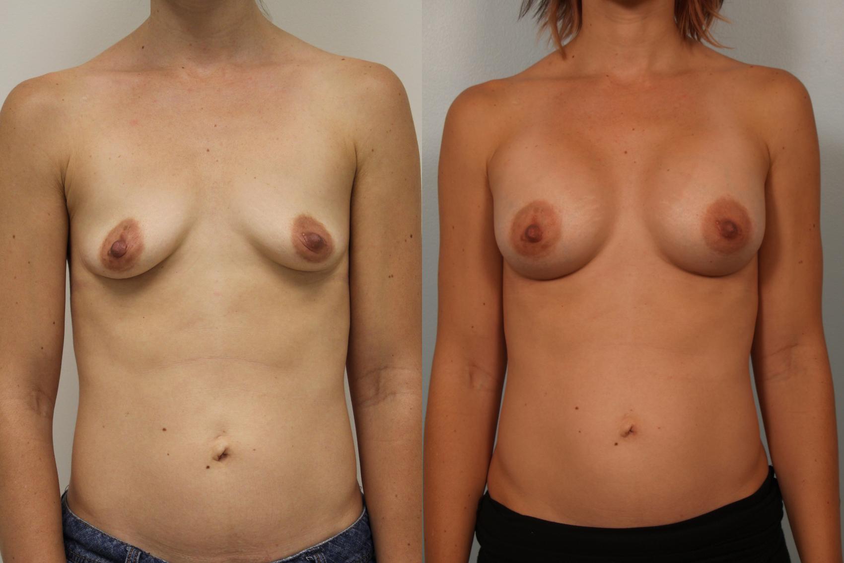 Before & After Breast Augmentation Case 54 View #1 View in Gilbert, AZ
