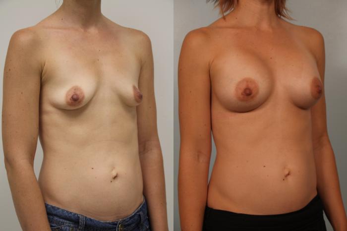 Before & After Breast Augmentation Case 54 View #4 View in Gilbert, AZ