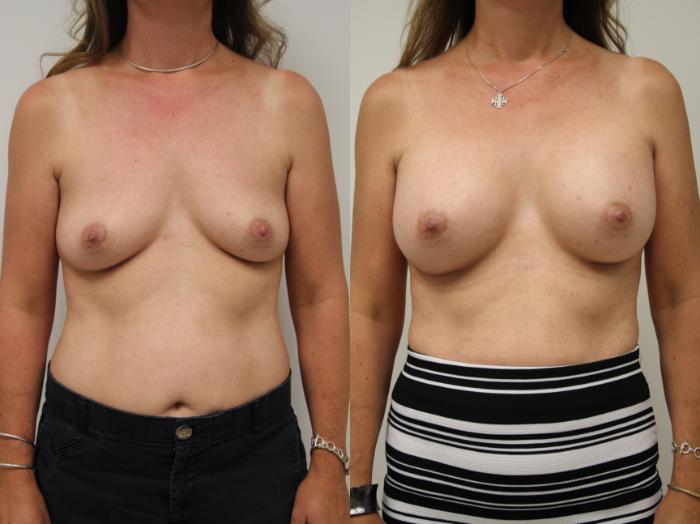 Before & After Breast Augmentation Case 55 View #1 View in Gilbert, AZ