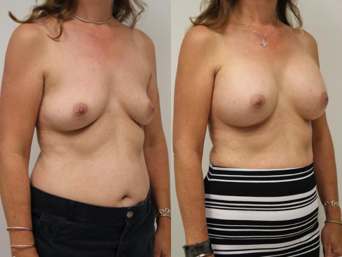 Before & After Breast Augmentation Case 55 View #2 View in Gilbert, AZ