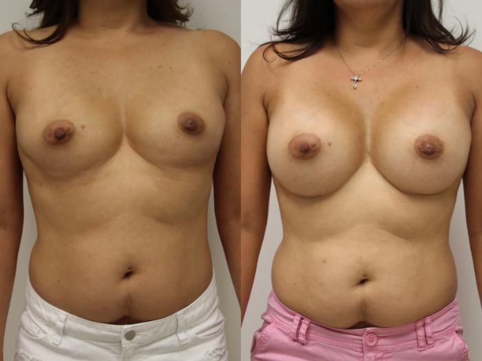 Before & After Breast Augmentation Case 56 View #1 View in Gilbert, AZ