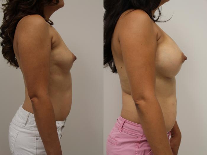 Before & After Breast Augmentation Case 56 View #2 View in Gilbert, AZ