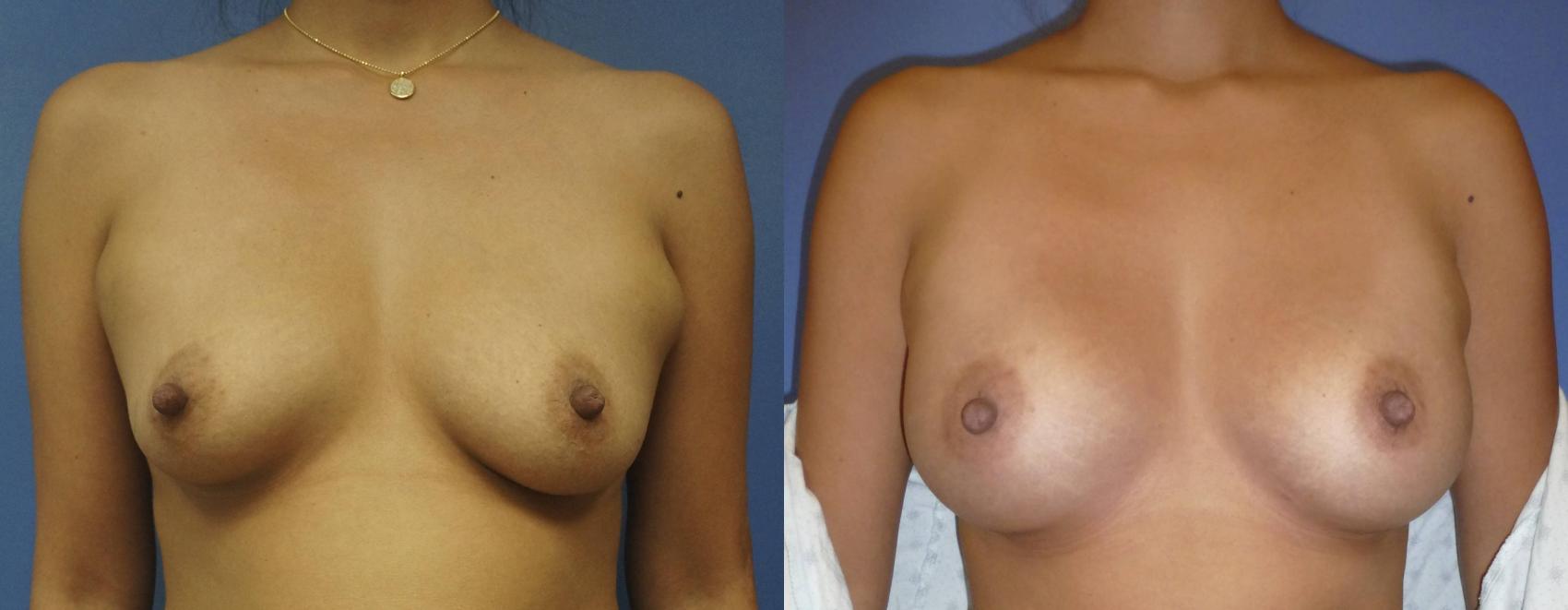 Before & After Breast Augmentation Case 6 View #1 View in Gilbert, AZ