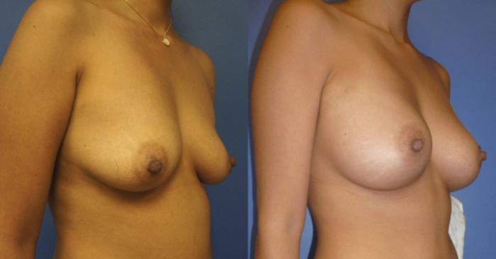 Before & After Breast Augmentation Case 6 View #2 View in Gilbert, AZ