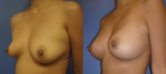 Before & After Breast Augmentation Case 6 View #3 View in Gilbert, AZ