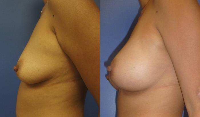 Before & After Breast Augmentation Case 6 View #4 View in Gilbert, AZ