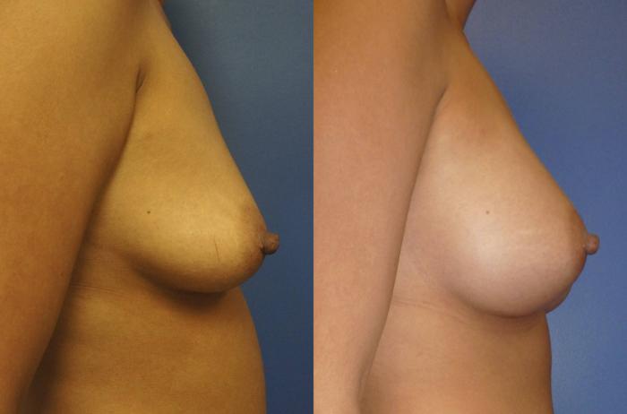 Before & After Breast Augmentation Case 6 View #5 View in Gilbert, AZ