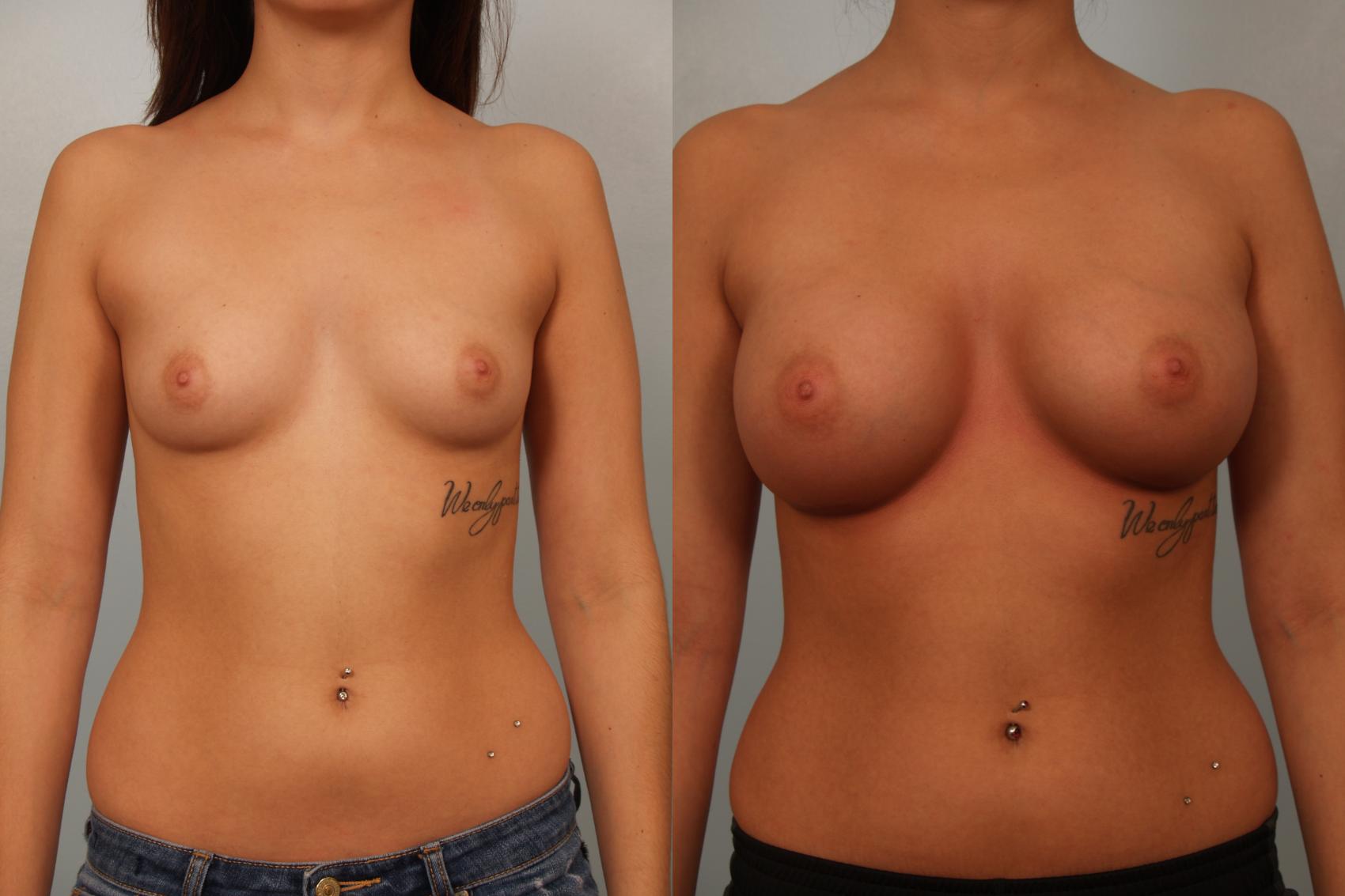 Before & After Breast Augmentation Case 60 View #1 View in Gilbert, AZ