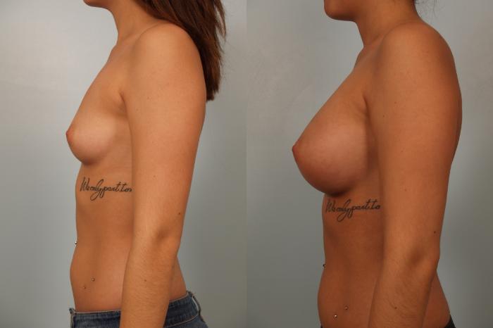 Before & After Breast Augmentation Case 60 View #2 View in Gilbert, AZ