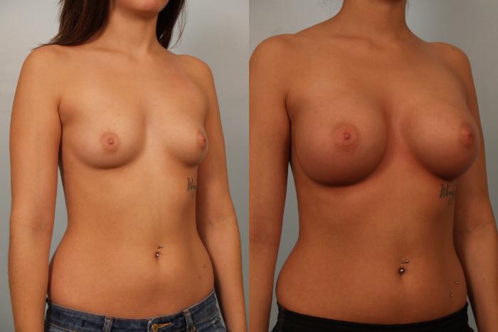 Before & After Breast Augmentation Case 60 View #3 View in Gilbert, AZ