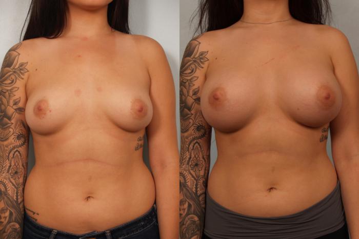 Before & After Breast Augmentation Case 61 View #1 View in Gilbert, AZ