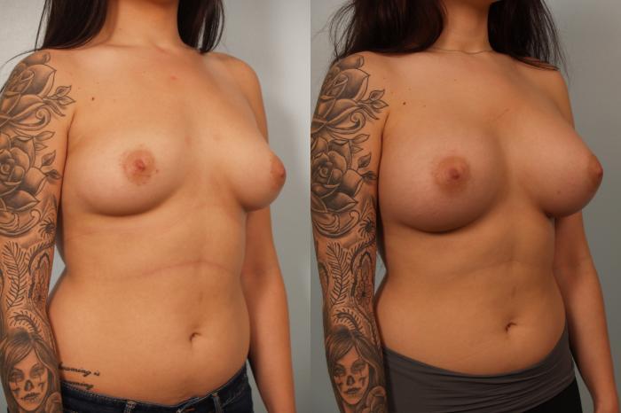 Before & After Breast Augmentation Case 61 View #2 View in Gilbert, AZ
