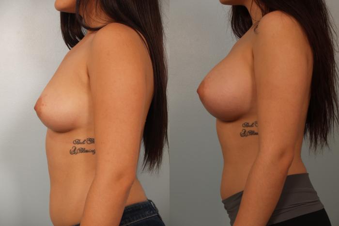 Before & After Breast Augmentation Case 61 View #3 View in Gilbert, AZ
