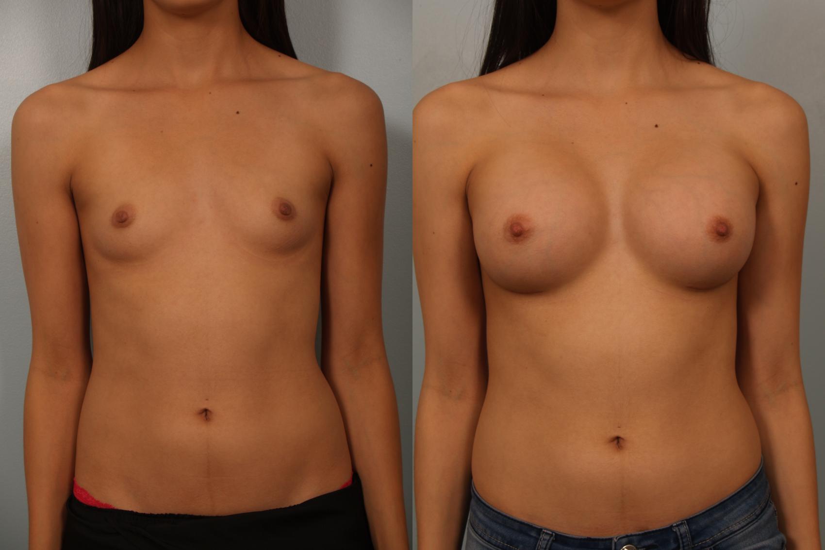 Before & After Breast Augmentation Case 63 View #1 View in Gilbert, AZ