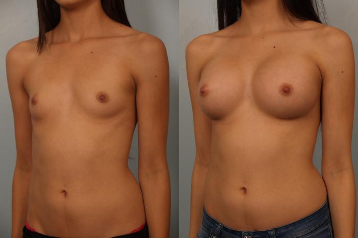 Before & After Breast Augmentation Case 63 View #2 View in Gilbert, AZ