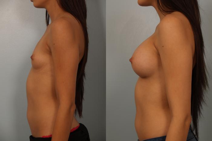 Before & After Breast Augmentation Case 63 View #3 View in Gilbert, AZ