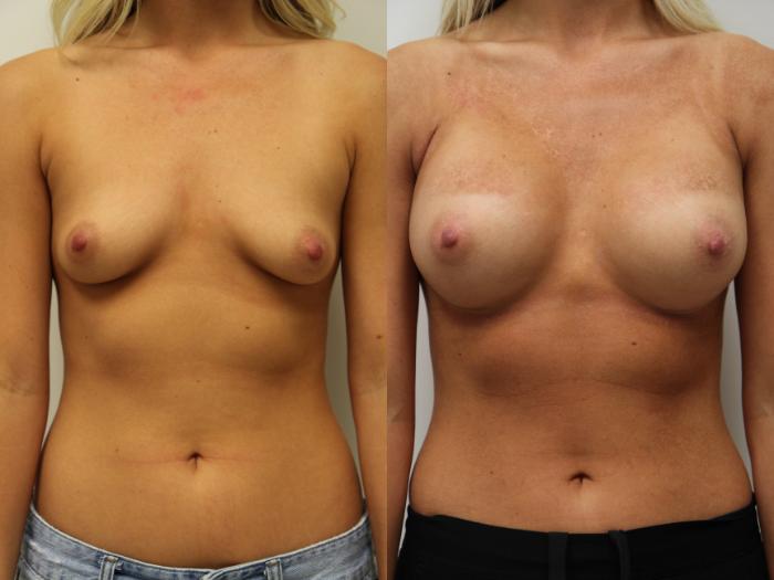 Before & After Breast Augmentation Case 73 View #1 View in Gilbert, AZ