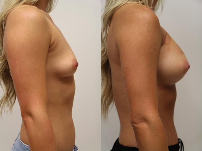Before & After Breast Augmentation Case 73 View #2 View in Gilbert, AZ