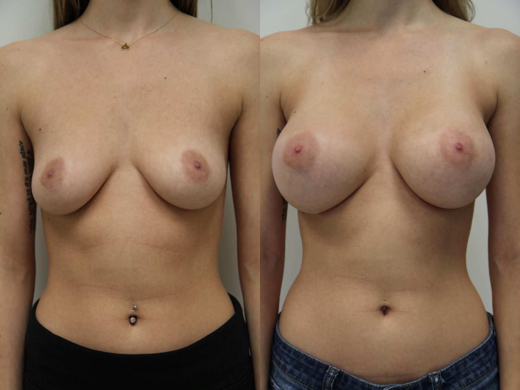 Before & After Breast Augmentation Case 74 View #1 View in Gilbert, AZ