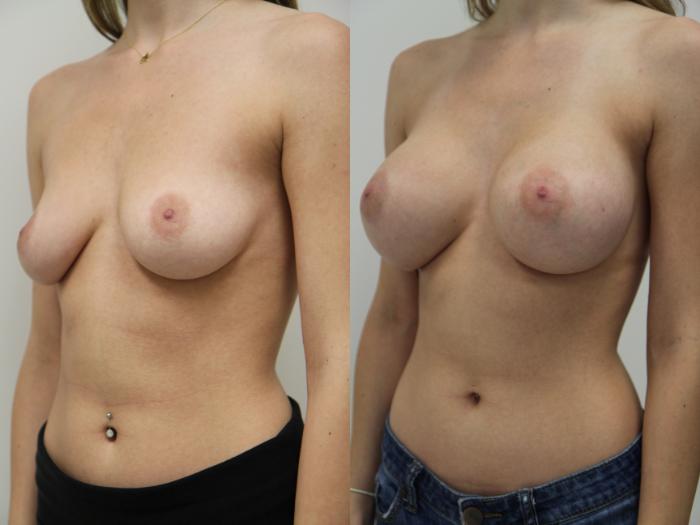 Before & After Breast Augmentation Case 74 View #2 View in Gilbert, AZ