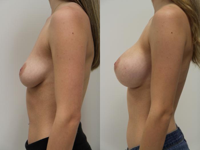 Before & After Breast Augmentation Case 74 View #3 View in Gilbert, AZ