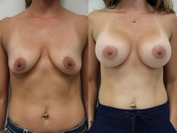 Before & After Breast Augmentation Case 76 View #1 View in Gilbert, AZ