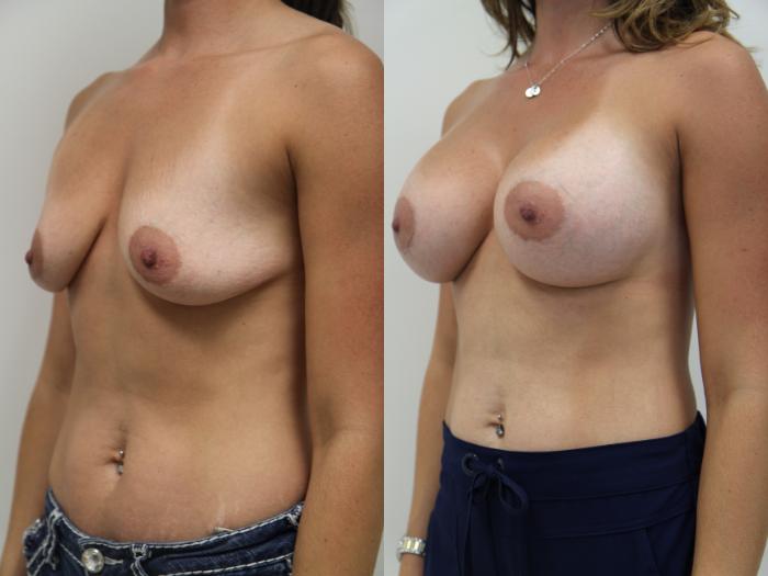 Before & After Breast Augmentation Case 76 View #3 View in Gilbert, AZ