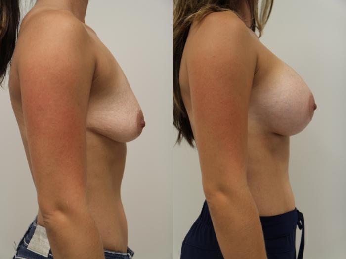 Before & After Breast Augmentation Case 76 View #4 View in Gilbert, AZ