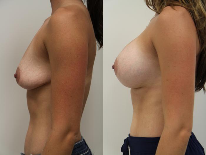 Before & After Breast Augmentation Case 76 View #5 View in Gilbert, AZ