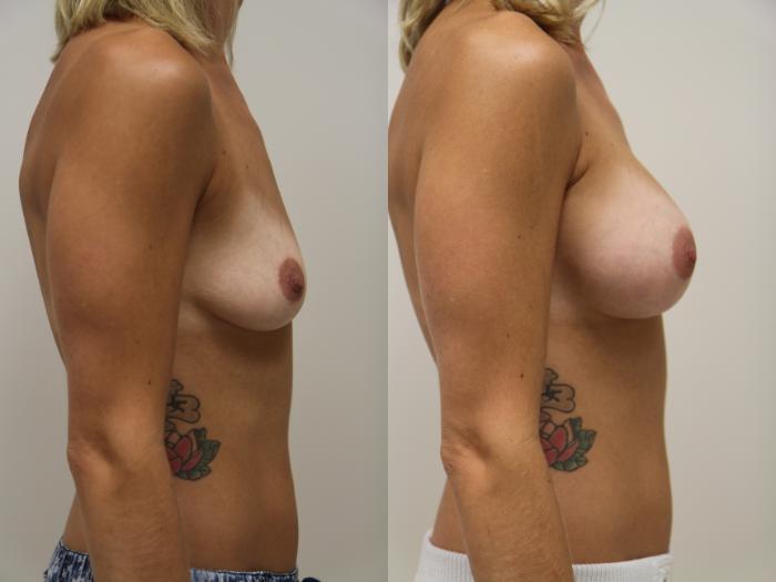 Before & After Breast Augmentation Case 78 View #3 View in Gilbert, AZ