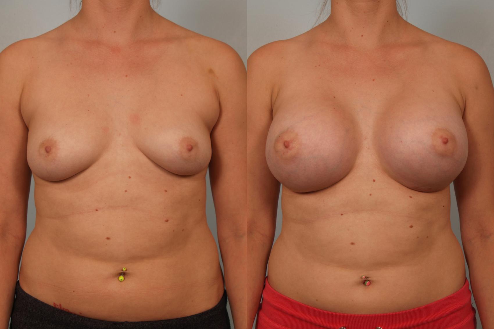 Before & After Breast Augmentation Case 82 View #1 View in Gilbert, AZ