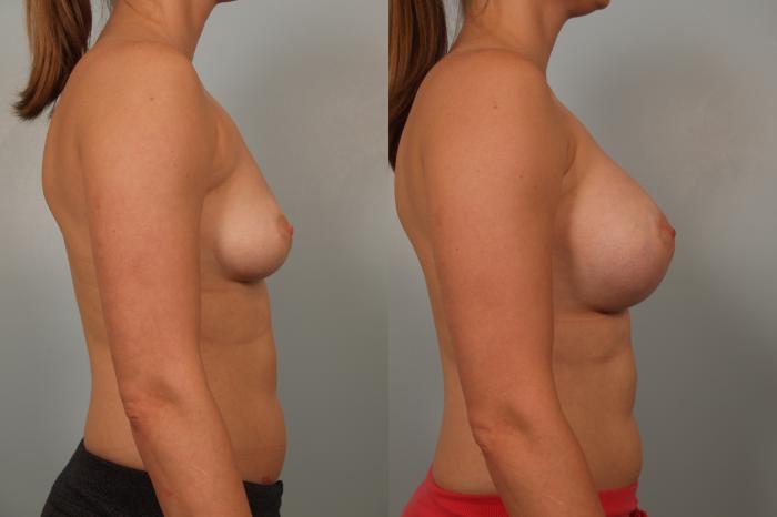 Before & After Breast Augmentation Case 82 View #2 View in Gilbert, AZ