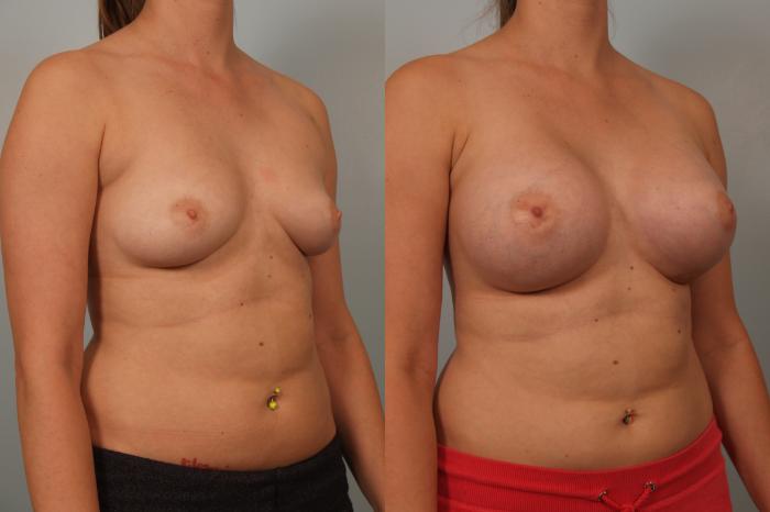 Before & After Breast Augmentation Case 82 View #3 View in Gilbert, AZ