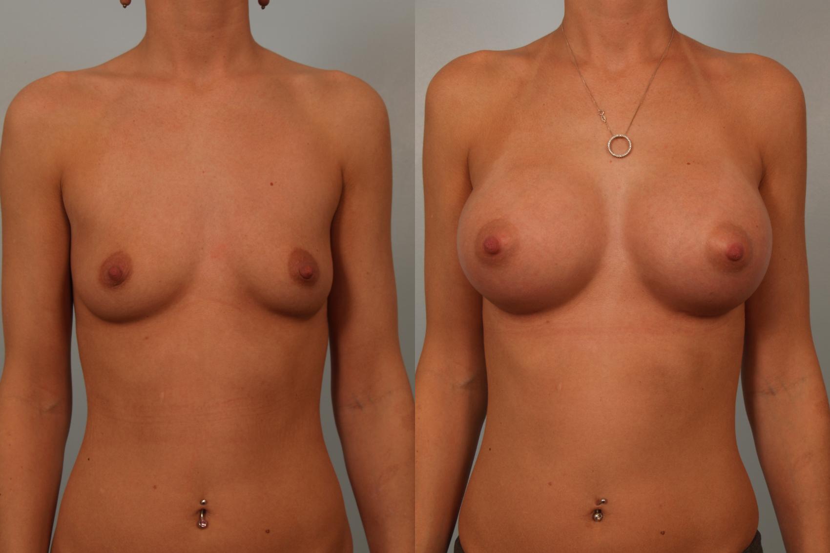 Before & After Breast Augmentation Case 84 View #1 View in Gilbert, AZ