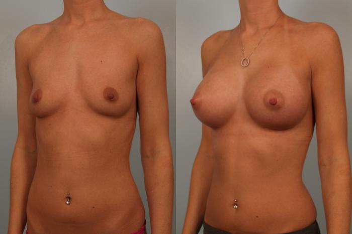 Before & After Breast Augmentation Case 84 View #2 View in Gilbert, AZ