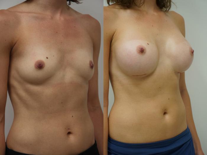 Before & After Breast Augmentation Case 88 View #1 View in Gilbert, AZ