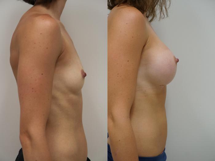 Before & After Breast Augmentation Case 88 View #2 View in Gilbert, AZ