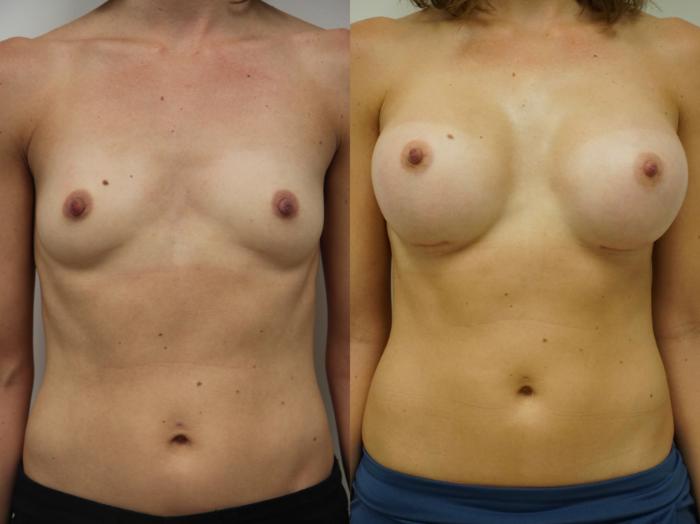 Before & After Breast Augmentation Case 88 View #3 View in Gilbert, AZ