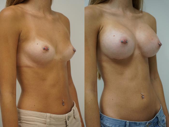 Before & After Breast Augmentation Case 89 View #1 View in Gilbert, AZ