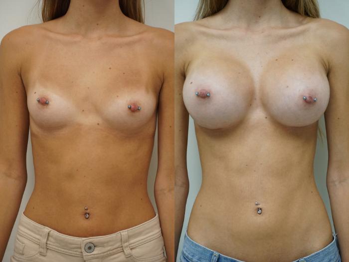 Before & After Breast Augmentation Case 89 View #2 View in Gilbert, AZ