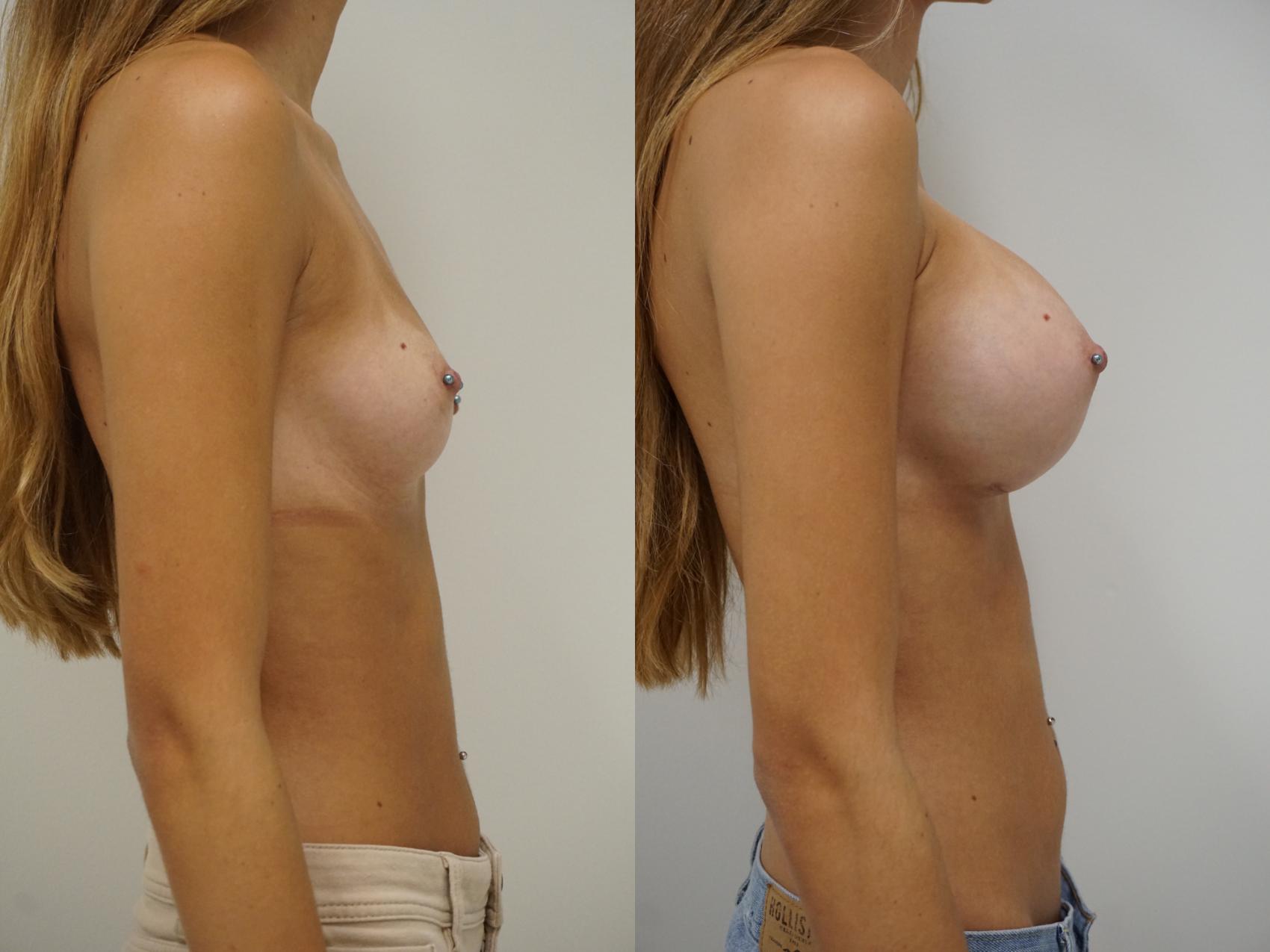 Before & After Breast Augmentation Case 89 View #3 View in Gilbert, AZ