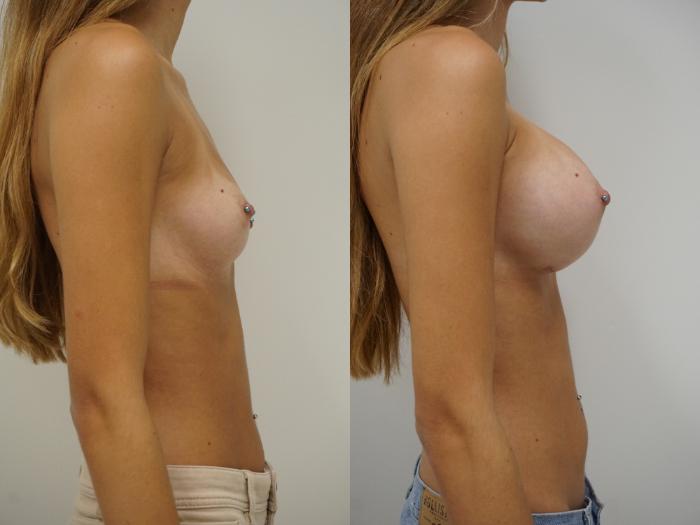 Before & After Breast Augmentation Case 89 View #3 View in Gilbert, AZ
