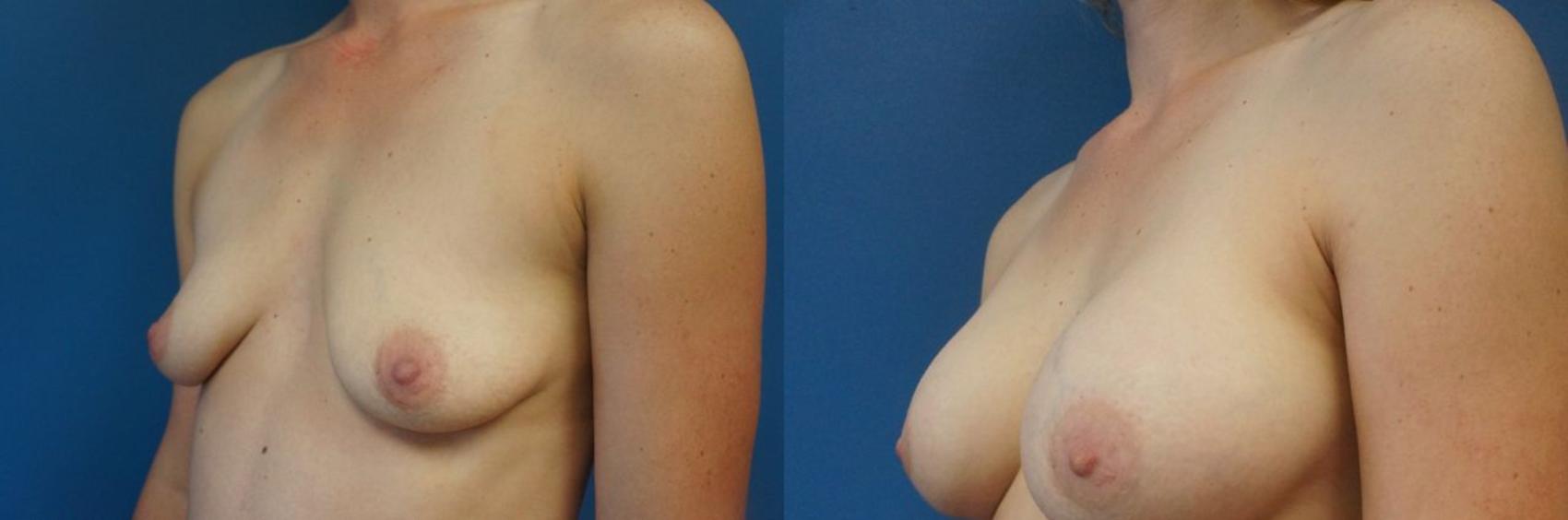 Before & After Breast Augmentation Case 9 View #2 View in Gilbert, AZ