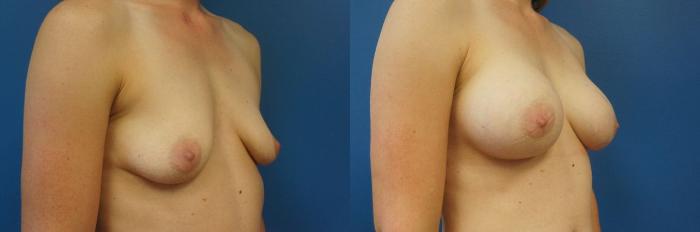 Before & After Breast Augmentation Case 9 View #4 View in Gilbert, AZ
