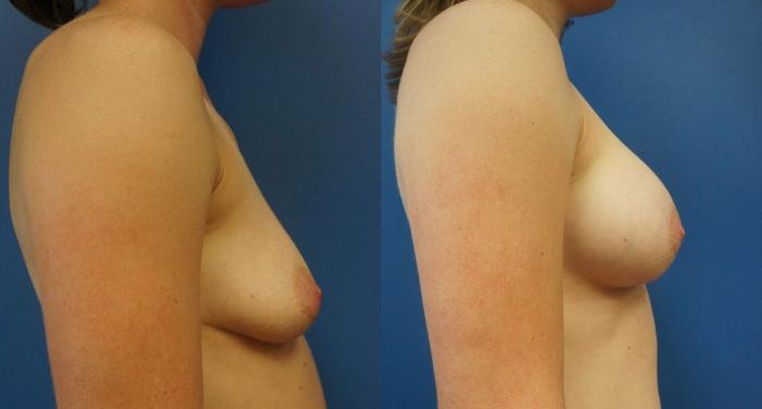 Before & After Breast Augmentation Case 9 View #5 View in Gilbert, AZ