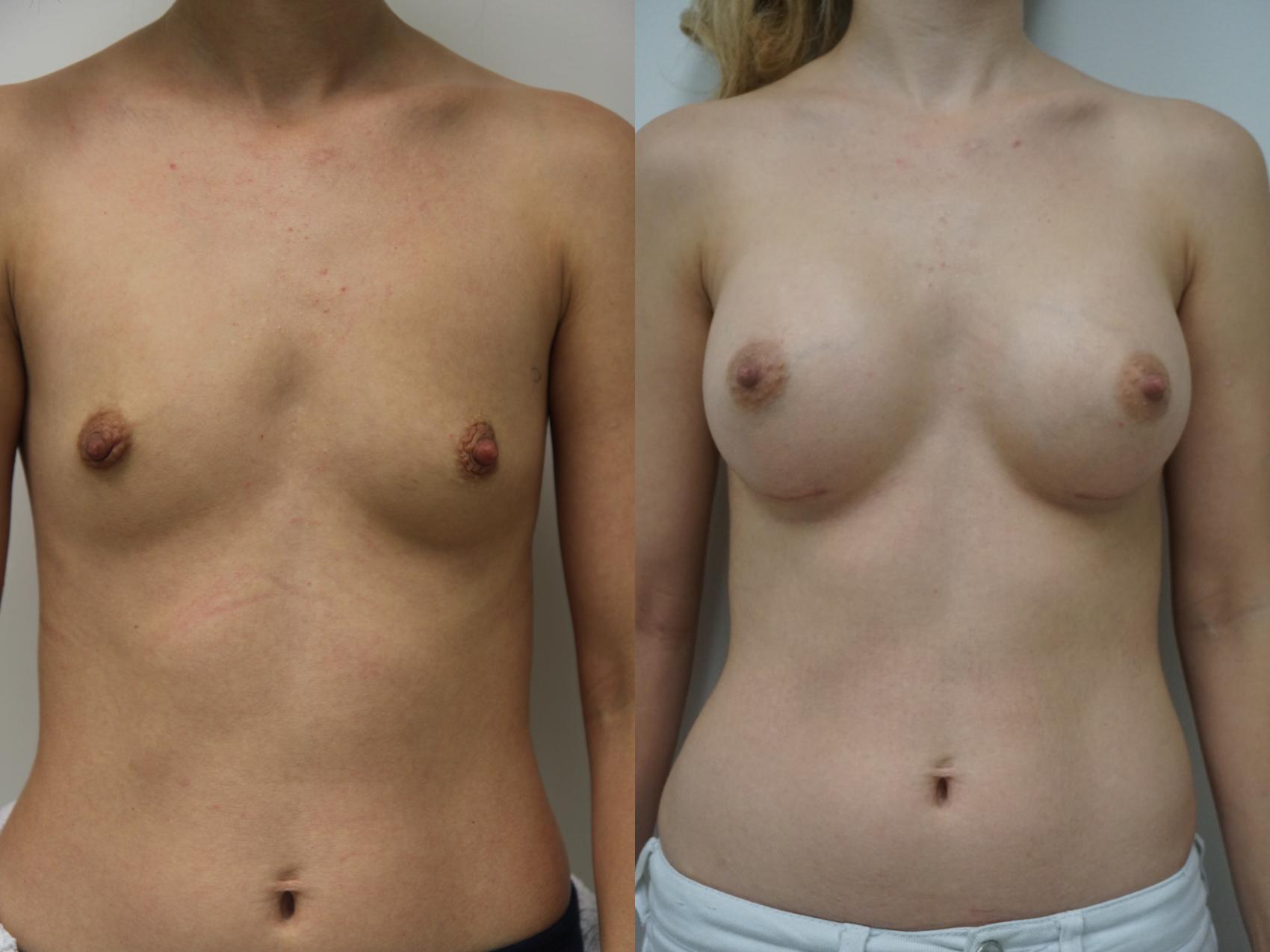 Before & After Breast Augmentation Case 90 View #1 View in Gilbert, AZ