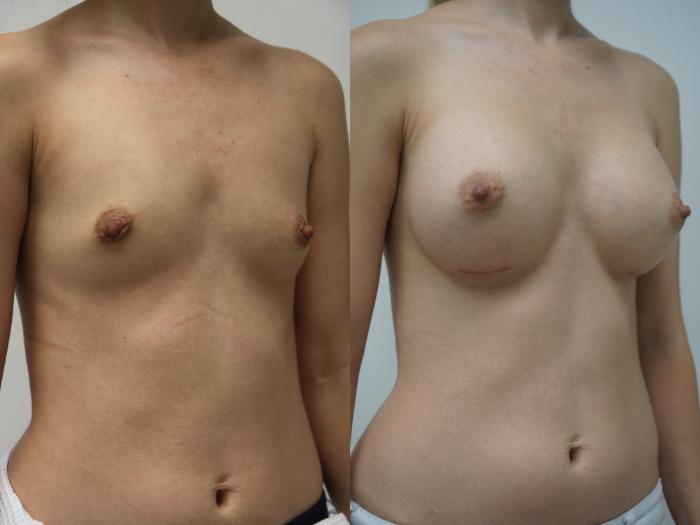 Before & After Breast Augmentation Case 90 View #2 View in Gilbert, AZ