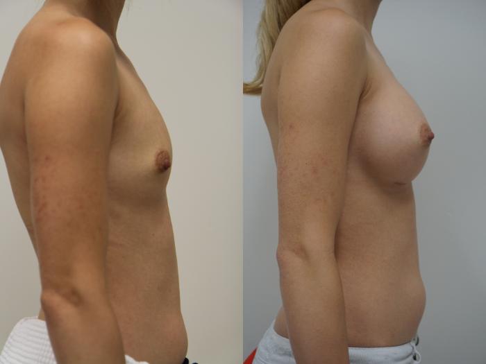 Before & After Breast Augmentation Case 90 View #3 View in Gilbert, AZ