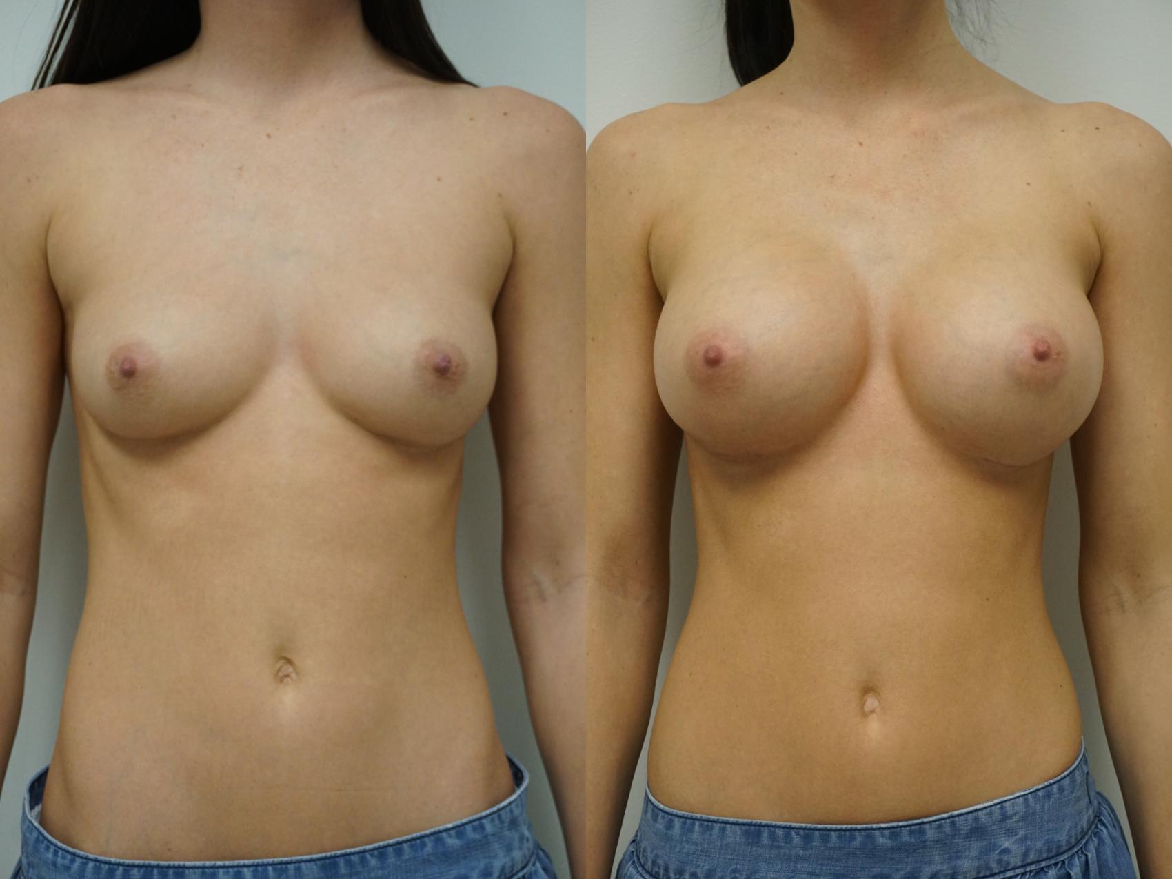Before & After Breast Augmentation Case 92 View #1 View in Gilbert, AZ